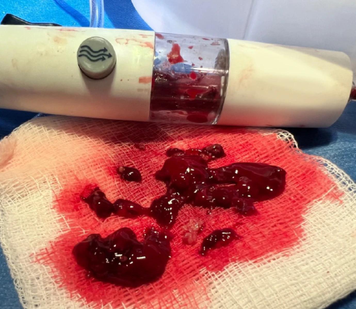 Clot removed from HotShot using the Prodigy Thrombectomy System